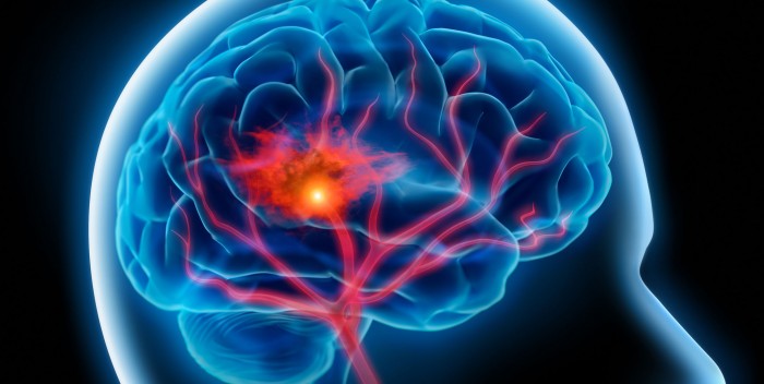 Mësoni se si të parandaloni sulmin në tru